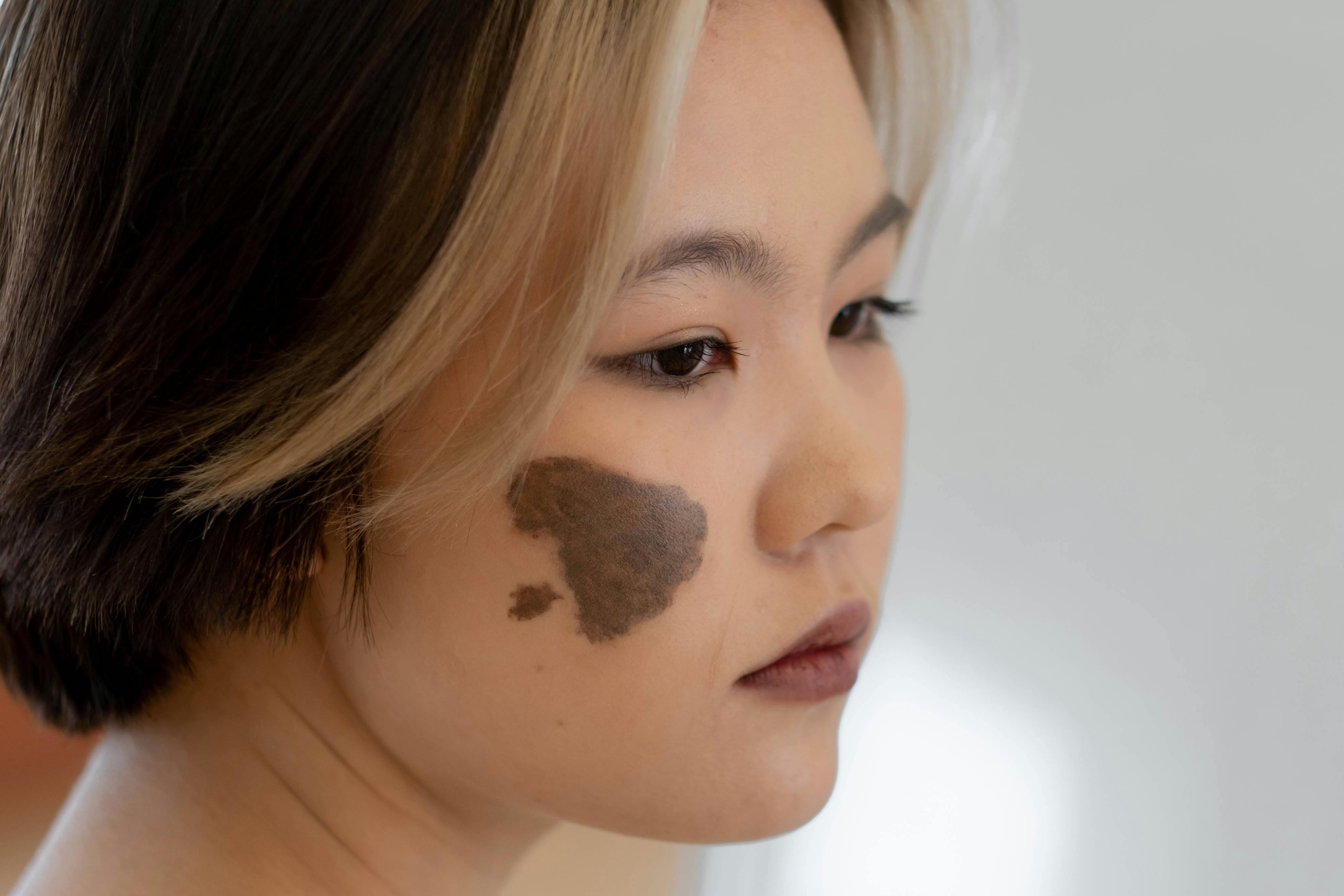 Brown Spots & Birthmarks
