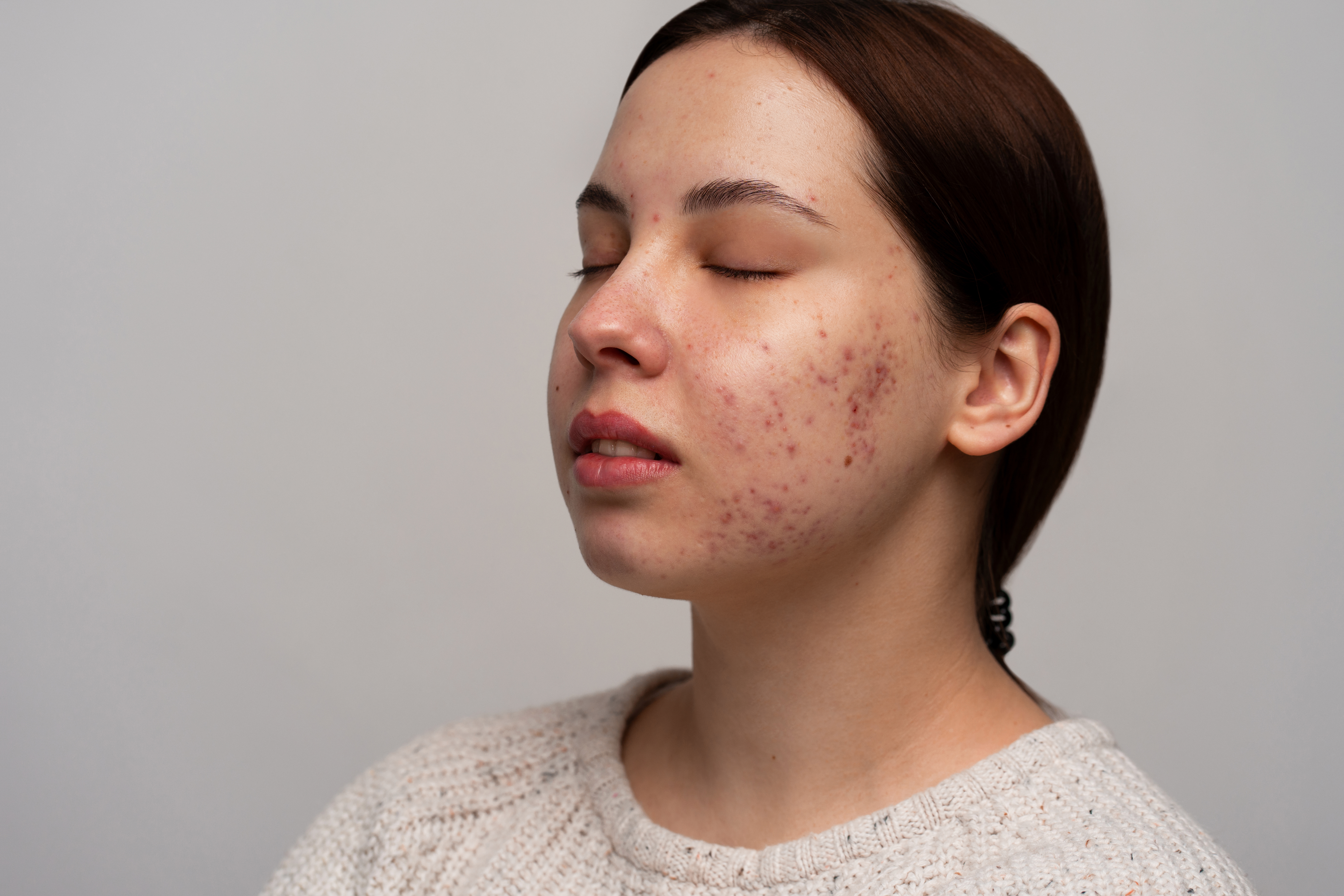 Melasma & Dark Patches
