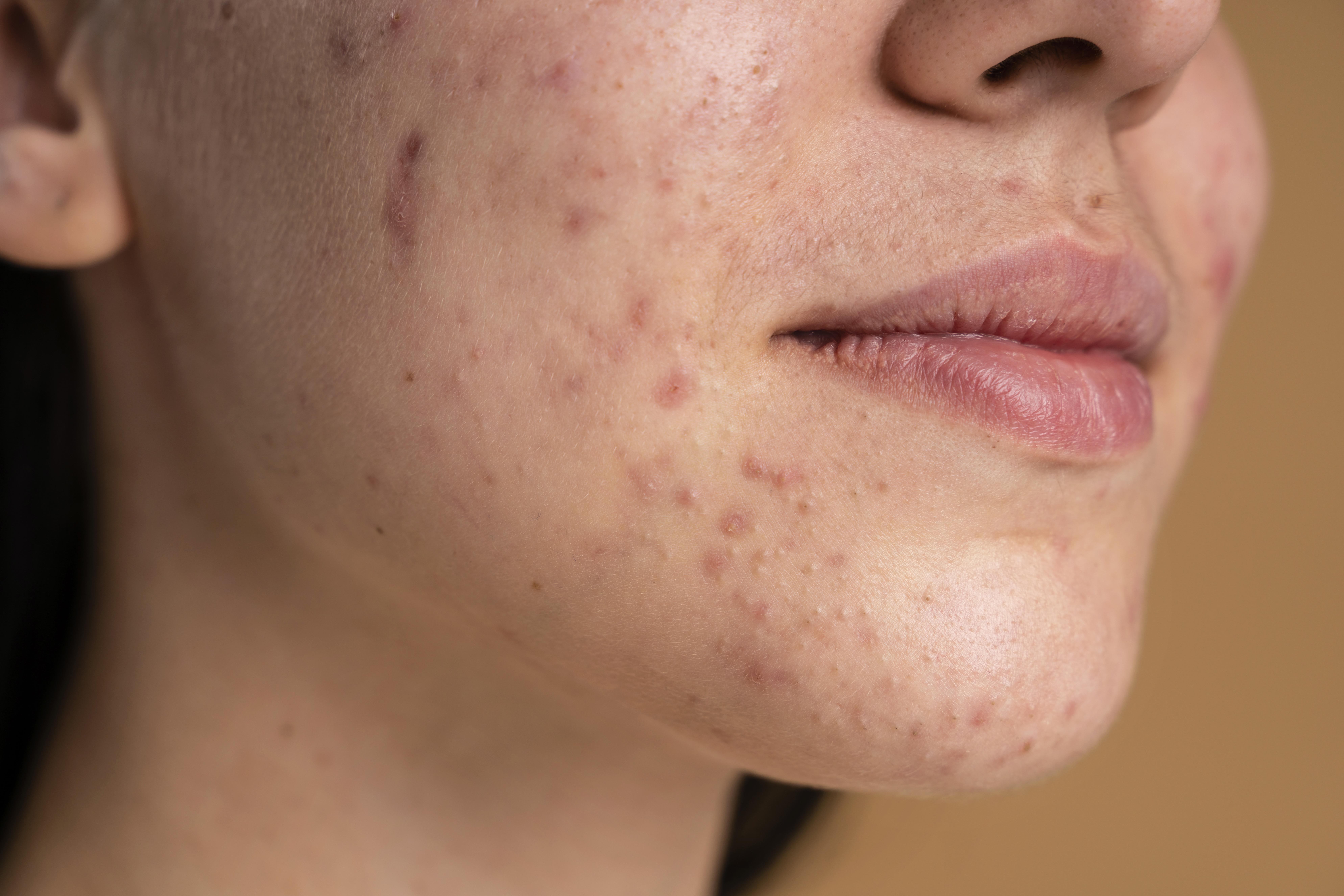 Pimple Marks & Acne Scars