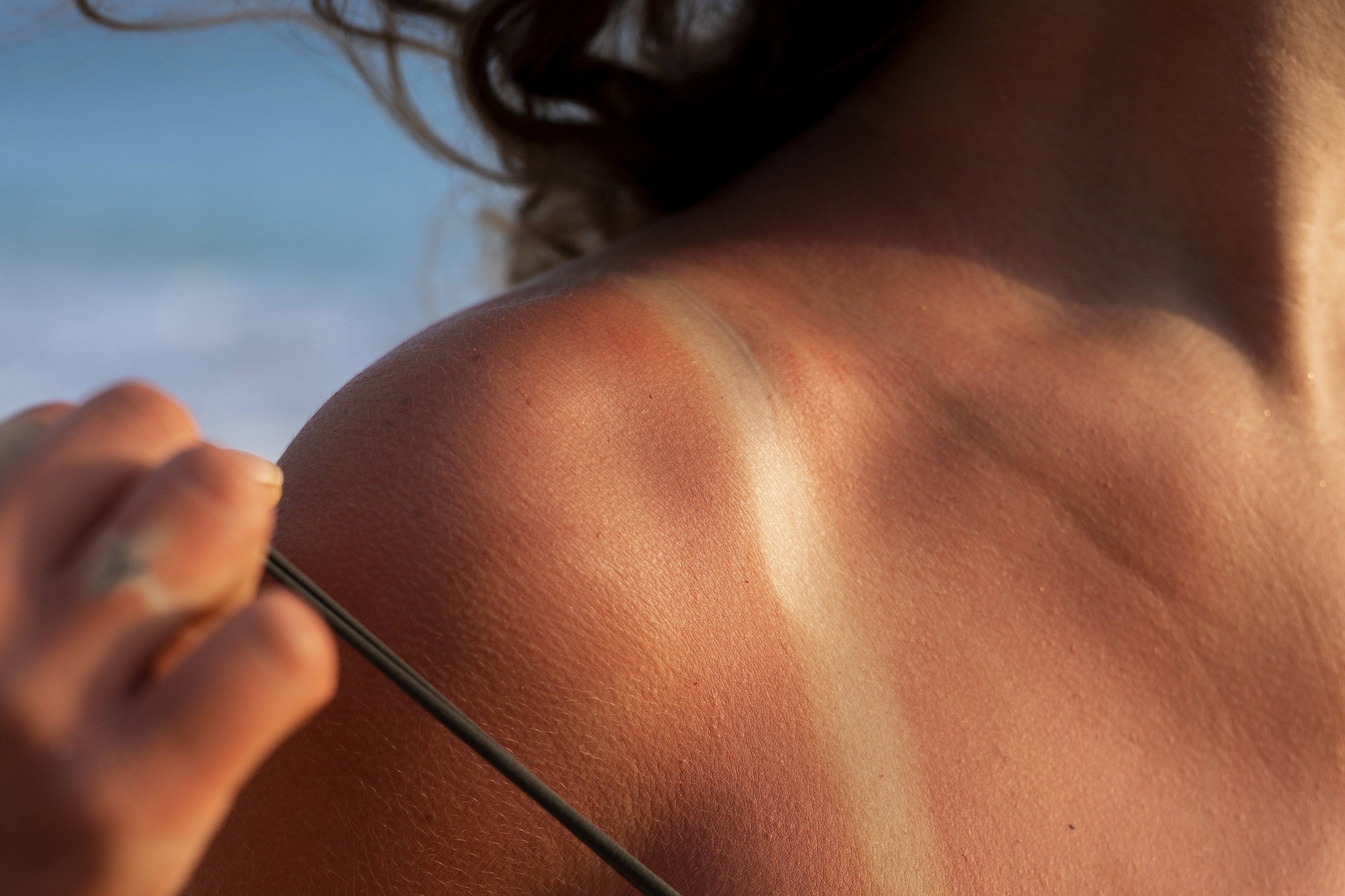Tanning & Uneven Skin Tone